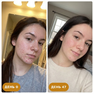 Golden набір anti-acne