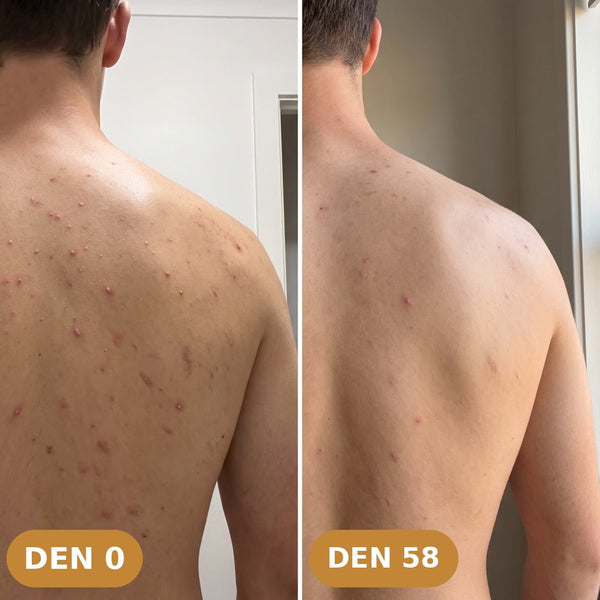 Golden anti-acne set