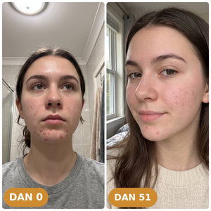 Golden anti-acne set